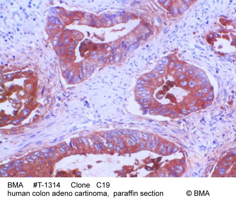 hp-t-1314_c19_human-colon-adeno-cartinoma_paraffin-mw_0010.jpg