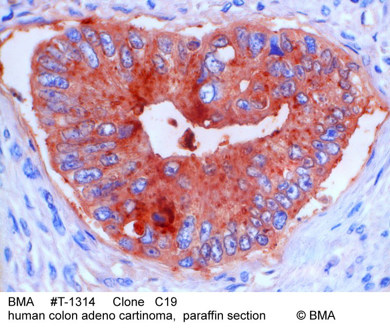 hp-t-1314_c19_human-colon-adeno-cartinoma_paraffin-mw_0011.jpg