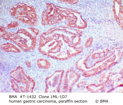 hp_t-1432_001_1ml-1d7_human_stomach_carinoma_paraf.jpg