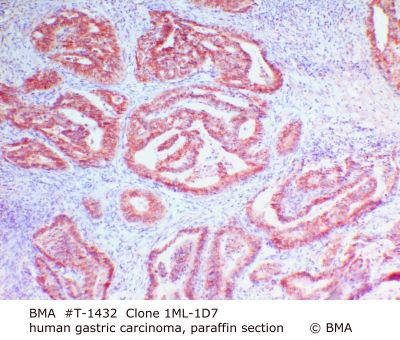 hp_t-1432_001_1ml-1d7_human_stomach_carinoma_paraf.jpg